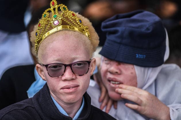 International Albinism Awareness Day in Kenya THIKA, KENYA - JUNE 13: People with albinism take part in activities marking International Albinism Awareness Day, advocating for equal participation in society and raising awareness about the challenges they face across Africa, including discrimination, exclusion and violent attacks, on June 13, 2026, in Thika, Kenya. The annual observance, led by the United Nations, aims to combat prejudice surrounding albinism, protect fundamental human rights and highlight global efforts to end violence against people with albinism. Gerald Anderson Anadolu Thika Kenya. Editorial use only. Please get in touch for any other usage.  Copyright: x2026xAnadoluxGeraldxAndersonx