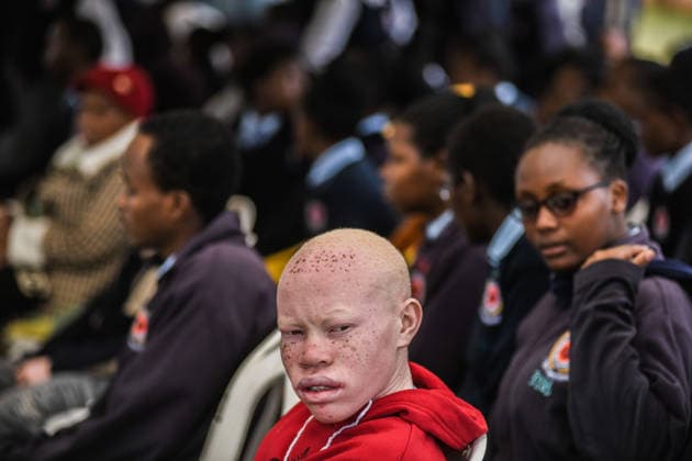 International Albinism Awareness Day in Kenya THIKA, KENYA - JUNE 13: People with albinism take part in activities marking International Albinism Awareness Day, advocating for equal participation in society and raising awareness about the challenges they face across Africa, including discrimination, exclusion and violent attacks, on June 13, 2026, in Thika, Kenya. The annual observance, led by the United Nations, aims to combat prejudice surrounding albinism, protect fundamental human rights and highlight global efforts to end violence against people with albinism. Gerald Anderson Anadolu Thika Kenya. Editorial use only. Please get in touch for any other usage.  Copyright: x2026xAnadoluxGeraldxAndersonx