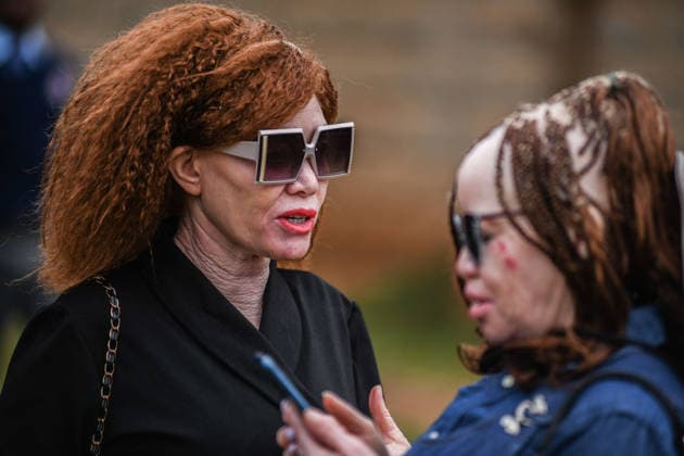 International Albinism Awareness Day in Kenya THIKA, KENYA - JUNE 13: People with albinism take part in activities marking International Albinism Awareness Day, advocating for equal participation in society and raising awareness about the challenges they face across Africa, including discrimination, exclusion and violent attacks, on June 13, 2026, in Thika, Kenya. The annual observance, led by the United Nations, aims to combat prejudice surrounding albinism, protect fundamental human rights and highlight global efforts to end violence against people with albinism. Gerald Anderson Anadolu Thika Kenya. Editorial use only. Please get in touch for any other usage.  Copyright: x2026xAnadoluxGeraldxAndersonx