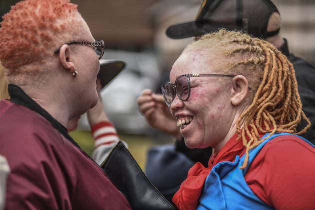 International Albinism Awareness Day in Kenya THIKA, KENYA - JUNE 13: People with albinism take part in activities marking International Albinism Awareness Day, advocating for equal participation in society and raising awareness about the challenges they face across Africa, including discrimination, exclusion and violent attacks, on June 13, 2026, in Thika, Kenya. The annual observance, led by the United Nations, aims to combat prejudice surrounding albinism, protect fundamental human rights and highlight global efforts to end violence against people with albinism. Gerald Anderson Anadolu Thika Kenya. Editorial use only. Please get in touch for any other usage.  Copyright: x2026xAnadoluxGeraldxAndersonx
