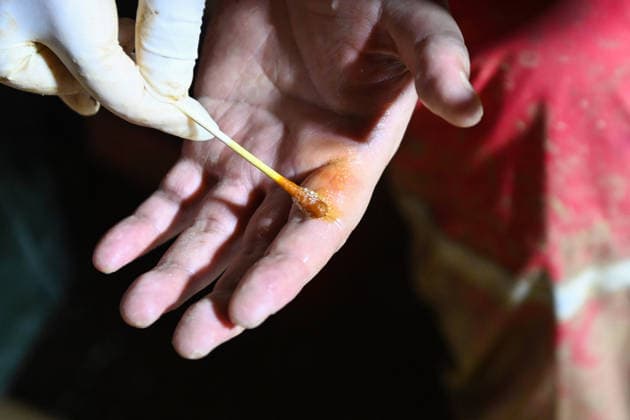 (260707) -- HENGZHOU, July 7, 2026 -- A medical personnel disinfects a cut in the hand of a rescuer in Hengzhou of Nanning City, south China s Guangxi Zhuang Autonomous Region, July 7, 2026. Record-breaking rainfall and the ensuing floods in parts of Nanning, capital city of south China s Guangxi Zhuang Autonomous Region, have left four people dead and eight others missing as of 10 a.m. Tuesday, according to a press conference on flood prevention and disaster relief held in Nanning. Hengzhou City and Binyang County, both currently under the jurisdiction of Nanning, recently experienced rainfall that broke local 24-hour meteorological records. The reported casualties were all in Hengzhou. ) CHINA-GUANGXI-NANNING-FLOOD-RESCUE (CN) CaoxYim 