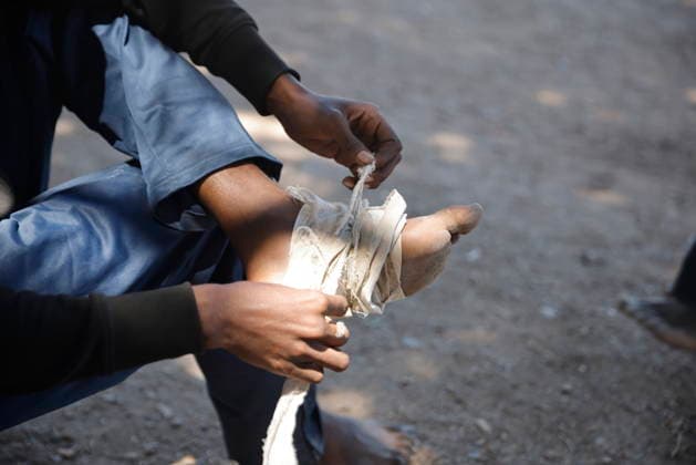 The barriers installed by the government in Ceuta are now fully operational. A person bandages a foot, August 2, 2026, in Ceuta, Spain. The Tarajal border has remained calm despite a small group of people attempting to cross by swimming, but they were intercepted by the Army. Although more than 48,000 migrants who had entered irregularly last Thursday have already left Ceuta, an unknown number of people who have refused to return remain in the city. AUGUST 2, 2026 PIXELATED MIGRATION CRISIS Jesú Ceuta Ceuta, Spain  Copyright: xJesusxTorresx 7699313
