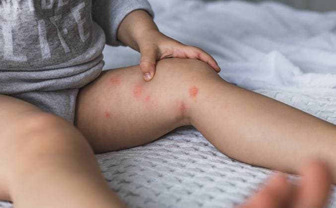 Babyfüße mit trockenen roten entzündeten Stellen bei Neurodermitis, Nahrungsmittelallergie oder Ekzemen. Konzept für Hauterkrankungen Baby feet with dry red inflamed spots of atopic dermatitis, food allergy or eczema disease. skin disease concept . Copyright: imageBROKER AlinaxKandybka ibxayk18766066.jpg ,model released, Symbolfoto ,property released