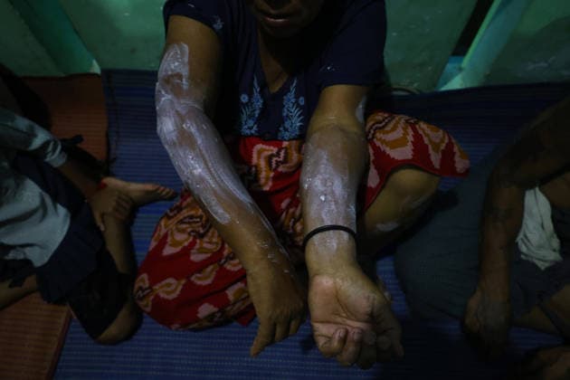 August 19, 2026, Ngathaingchaung, Ayeyarwady Division, Myanmar: A displaced resident applies medicine to a skin rash at a flood relief camp in Ngathaingchaung Township, Ayeyarwady Region..In Laymyethna Township, Ayeyarwady Region, the Ngawun River embankment collapsed on July 31, leaving nearby towns including Hinthada, Yegyi, Ngathaingchaung, Kyonpyaw and Kyaunggon still inundated, affecting tens of thousands of people, officials said. Ngathaingchaung Myanmar  - ZUMAn324 20260819_zip_n324_022 Copyright: xAyexMyaxNaingx