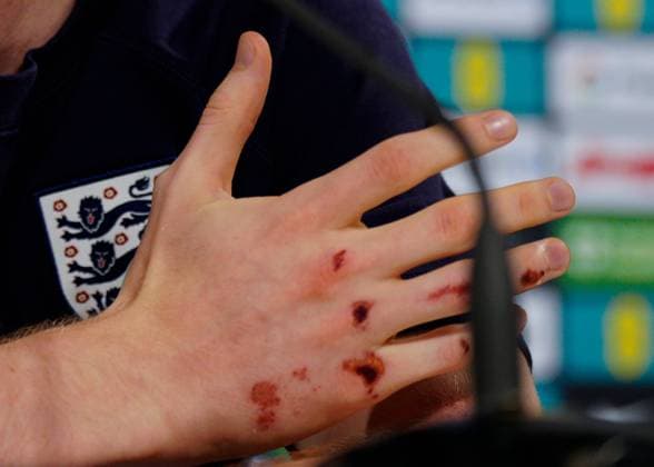 Anthony Gordon of England press conference, PK, Pressekonferenz showing his grazes and bruises from falling off electric bike England Press Conference, UEFA European Championship, EM, Europameisterschaft 2024, Round of 16, Football, Spa & Golf Resort Weimarer Land, Blankenhain, Germany, 28 Jun 2024 EDITORIAL USE ONLY No use with unauthorised audio, video, data, fixture lists, club league logos or live services. Online in-match use limited to 120 images, no video emulation. No use in betting, games or single club league player publications. Copyright: xDavexShopland Shutterstockx 14560774ah