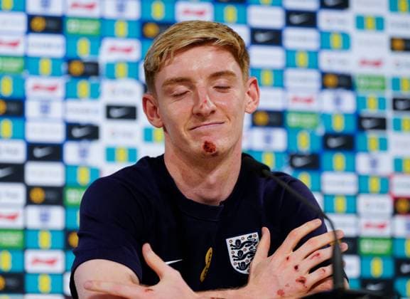 Anthony Gordon of England press conference, PK, Pressekonferenz showing his grazes and bruises from falling off electric bike England Press Conference, UEFA European Championship, EM, Europameisterschaft 2024, Round of 16, Football, Spa & Golf Resort Weimarer Land, Blankenhain, Germany, 28 Jun 2024 EDITORIAL USE ONLY No use with unauthorised audio, video, data, fixture lists, club league logos or live services. Online in-match use limited to 120 images, no video emulation. No use in betting, games or single club league player publications. Copyright: xDavexShopland Shutterstockx 14560774aj