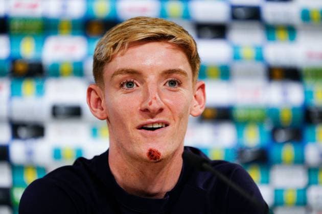 Anthony Gordon of England press conference, PK, Pressekonferenz showing his grazes and bruises from falling off electric bike England Press Conference, UEFA European Championship, EM, Europameisterschaft 2024, Round of 16, Football, Spa & Golf Resort Weimarer Land, Blankenhain, Germany, 28 Jun 2024 EDITORIAL USE ONLY No use with unauthorised audio, video, data, fixture lists, club league logos or live services. Online in-match use limited to 120 images, no video emulation. No use in betting, games or single club league player publications. Copyright: xDavexShopland Shutterstockx 14560774am