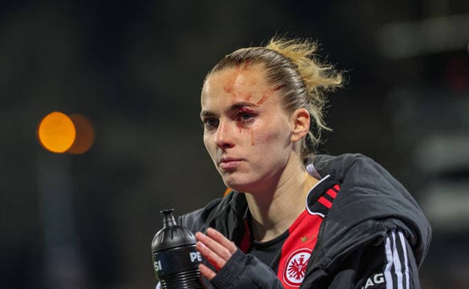 GER, Frankfurt, Eintracht Frankfurt vs TSG Hoffenheim, Google Pixel Bundesliga, Fussball, DFB, Spielzeit 2025 2026, Stadion am Brentanobad, 15. Spieltag im Bild: Verletzung bei Laura Freigang (Eintracht Frankfurt Frauen 10), Blut, Auge, verletzt, Auswechslung DFB DFL REGULATIONS PROHIBIT ANY USE OF PHOTOGRAPHS AS IMAGE SEQUENCES AND OR QUASI-VIDEO, 18.03.2026 Copyright: HMBxMedia HendrikxHamelau