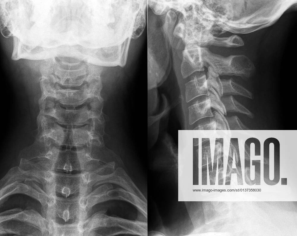 Röntgenbild,röntgen,halswirbel,röntgenaufnahme,röntgenaufnahmen,röntgenbilder,halswirbelsäule,hws,pars cervicalis