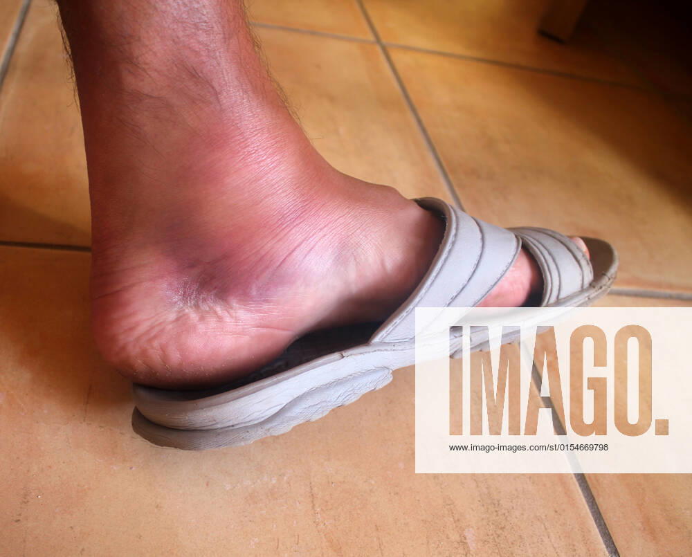Broken ankle,foot man , 12172252.jpg, accident, ankle, background, bare, bone, break, bruise, care, caucasian, close-up, european, foot, fracture, fractured, healing, health, heath-care, hemorrhage, horizontal, human, injured, injury, insurance, leg, man, medical, medicine, pain, patient, people, physical, profile, serious, sick, skin, sports, swollen, toes, view, flaps, floor, swelling,