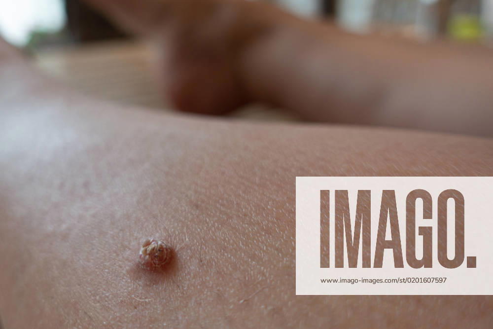 An unattractive wart has formed on the shinbone