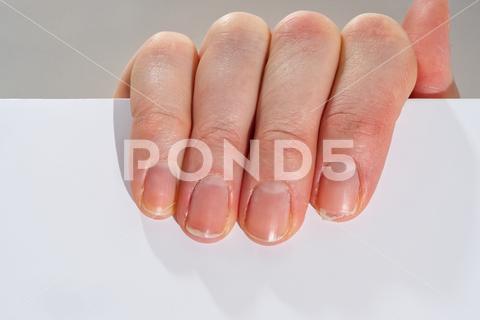 Close-up of brittle nails on woman's hands. Female broken fingernail. weak sore nails. nail, broken, closeup, finger, hand, woman, weak, sore, nails, health, care, skin, manicure, treatment, fingernail, pain, medical, healthy, hygiene, medicine, dry, clean, people, person, ridges, body, background, peeling, brittle, white, gel-lacquer, damaged, unhealthy, gesturing, pitted, fracture, makeup, shellac, break, accident, destroy, fresh, beauty