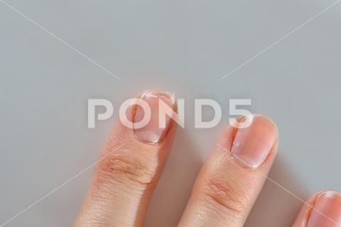 Close-up of brittle nails on woman's hands. Female broken fingernail. weak sore nails. nail, broken, closeup, finger, hand, woman, weak, sore, nails, health, care, skin, manicure, treatment, fingernail, pain, medical, healthy, hygiene, medicine, dry, clean, people, person, ridges, body, background, peeling, brittle, white, gel-lacquer, damaged, unhealthy, gesturing, pitted, fracture, makeup, shellac, break, accident, destroy, fresh, beauty