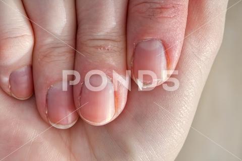 Close-up of brittle nails on woman's hands. Female broken fingernail. weak sore nails. nail, broken, closeup, finger, hand, woman, weak, sore, nails, health, care, skin, manicure, treatment, fingernail, pain, medical, healthy, hygiene, medicine, dry, clean, people, person, ridges, body, background, peeling, brittle, white, gel-lacquer, damaged, unhealthy, gesturing, pitted, fracture, makeup, shellac, break, accident, destroy, fresh, beauty
