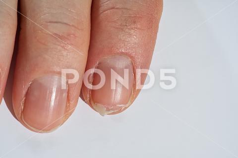 Close-up of brittle nails on woman's hands. Female broken fingernail. weak sore nails. nail, broken, closeup, finger, hand, woman, weak, sore, nails, health, care, skin, manicure, treatment, fingernail, pain, medical, healthy, hygiene, medicine, dry, clean, people, person, ridges, body, background, peeling, brittle, white, gel-lacquer, damaged, unhealthy, gesturing, pitted, fracture, makeup, shellac, break, accident, destroy, fresh, beauty