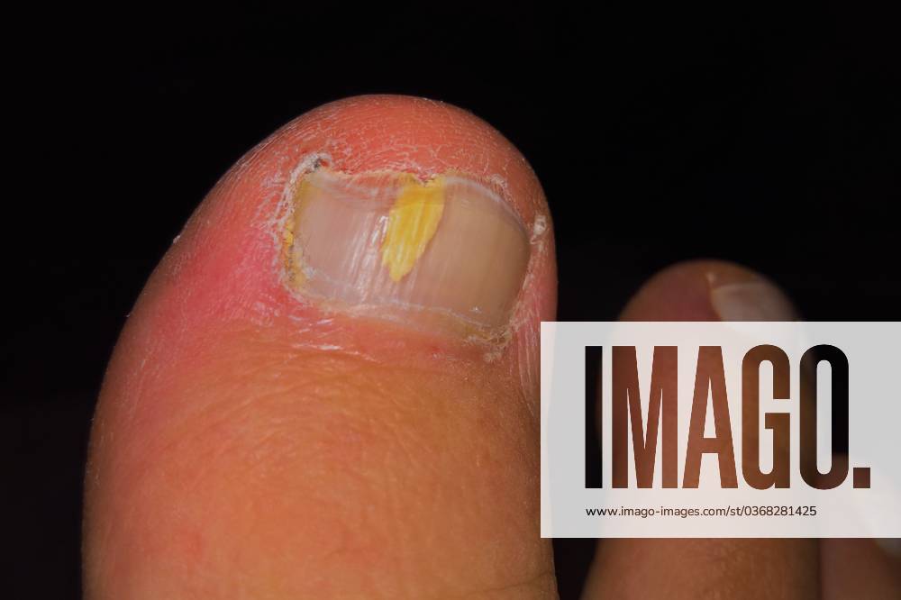 Nagelpilz, auch Nagelmykose oder Onychomykose, ist eine Infektion der Zehen- oder Fingernägel durch Dermatophyten - sprich Fadenpilze, Hefepilze - sprich Sprosspilze oder Schimmelpilze. Innere endogene Dispositionsfaktoren können beispielsweise Stoffwechselerkrankungen sein. Arzt, Hausarzt, Hautarzt, vermutliche Diagnose: Nagelpilz - Dermatophyten