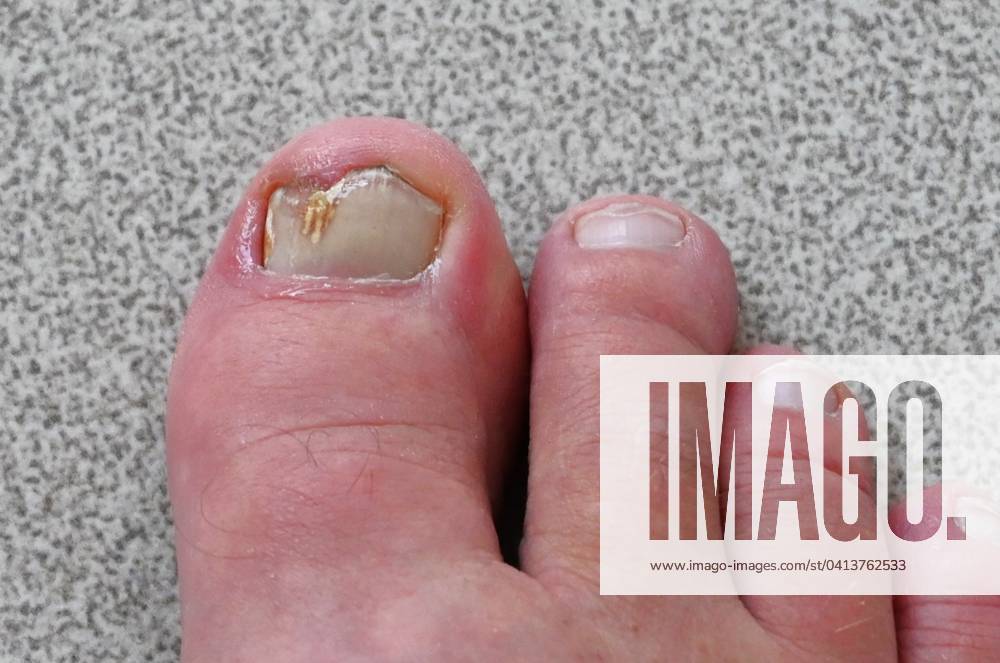 Nagelpilz, auch Nagelmykose oder Onychomykose, ist eine Infektion der Zehen- oder Fingernägel durch Dermatophyten - sprich Fadenpilze, Hefepilze - sprich Sprosspilze oder Schimmelpilze. Innere endogene Dispositionsfaktoren können beispielsweise Stoffwechselerkrankungen sein. Arzt, Hausarzt, Hautarzt. Diagnose: Nagelpilz - Dermatophyten