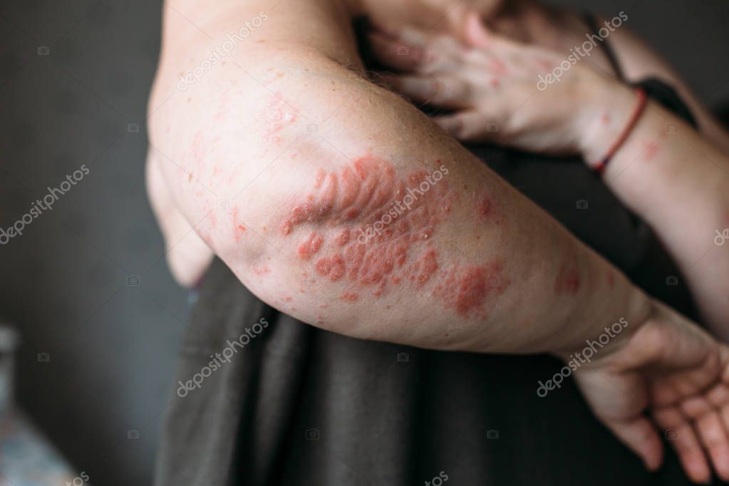 Psoriasis on elbow. Closeup photo of dry skin