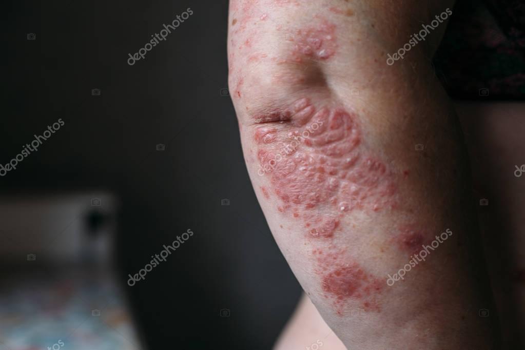 Psoriasis on elbow. Closeup photo of dry skin