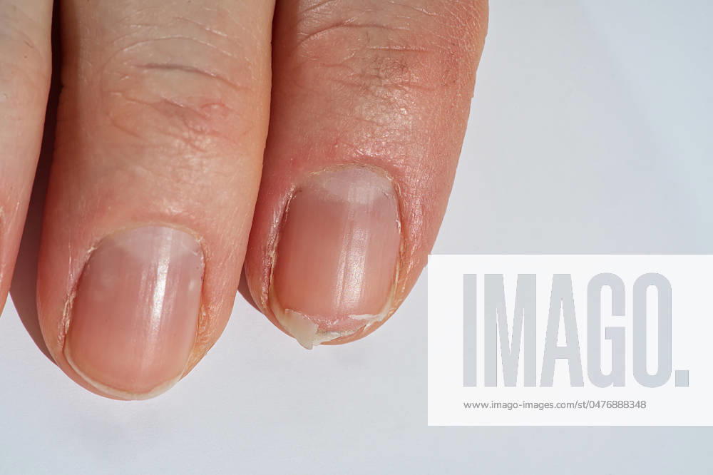 Close-up of brittle nails on woman s hands. Female broken fingernail. Close-up of brittle nails on woman s hands. Female broken fingernail. weak sore nails.