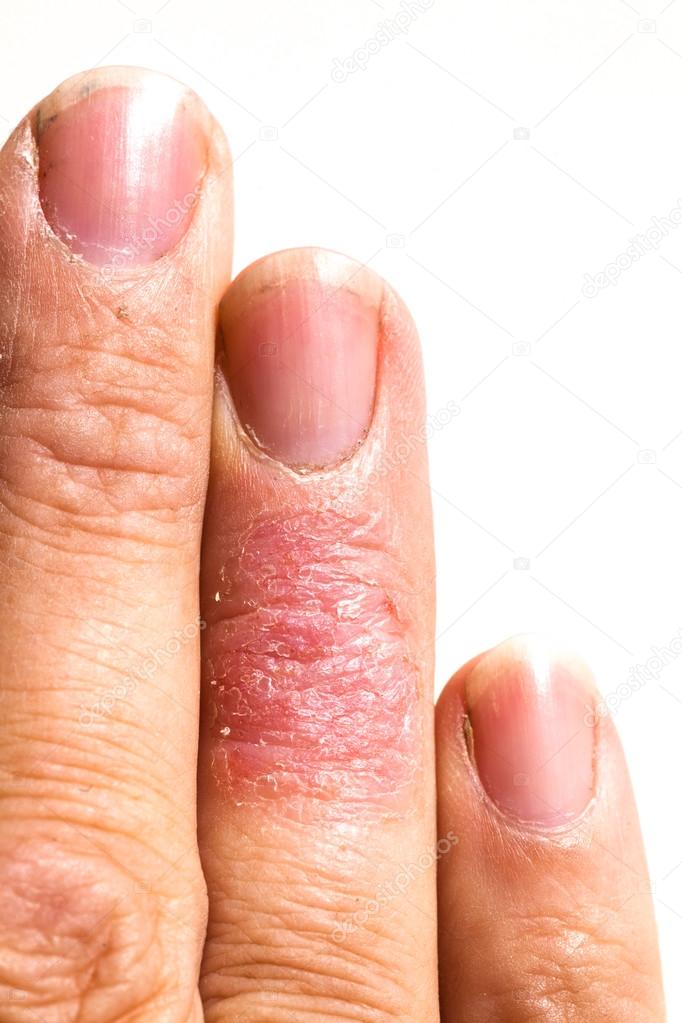 Eczema dermatitis allergic skin rash closup region on adult finger. Isolated white background.