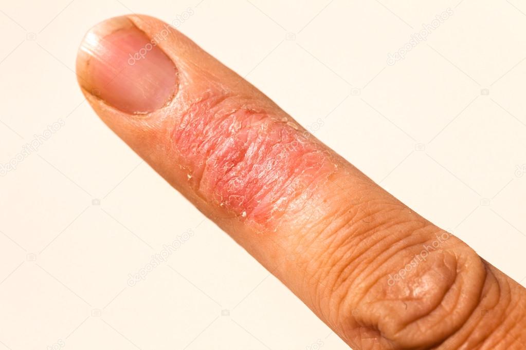 Eczema dermatitis allergic skin rash closup region on adult finger. Isolated white background.