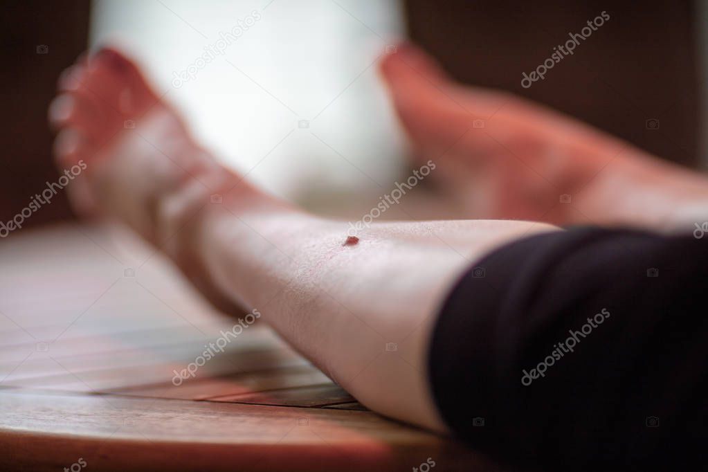 An unattractive wart has formed on the shinbone
