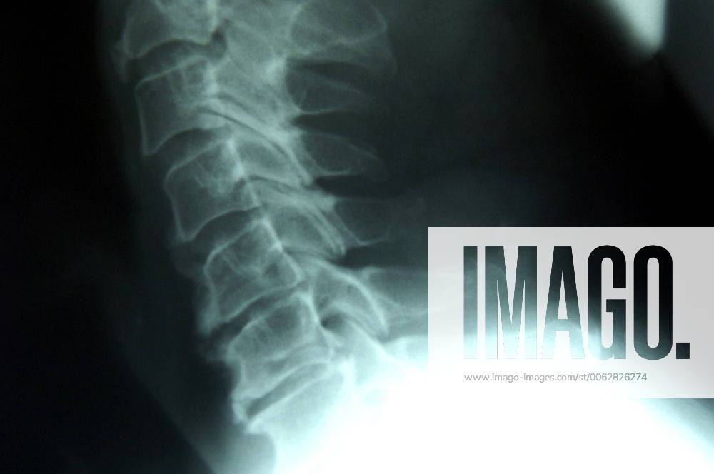X-Ray of a Female Lumbar Vertibrae