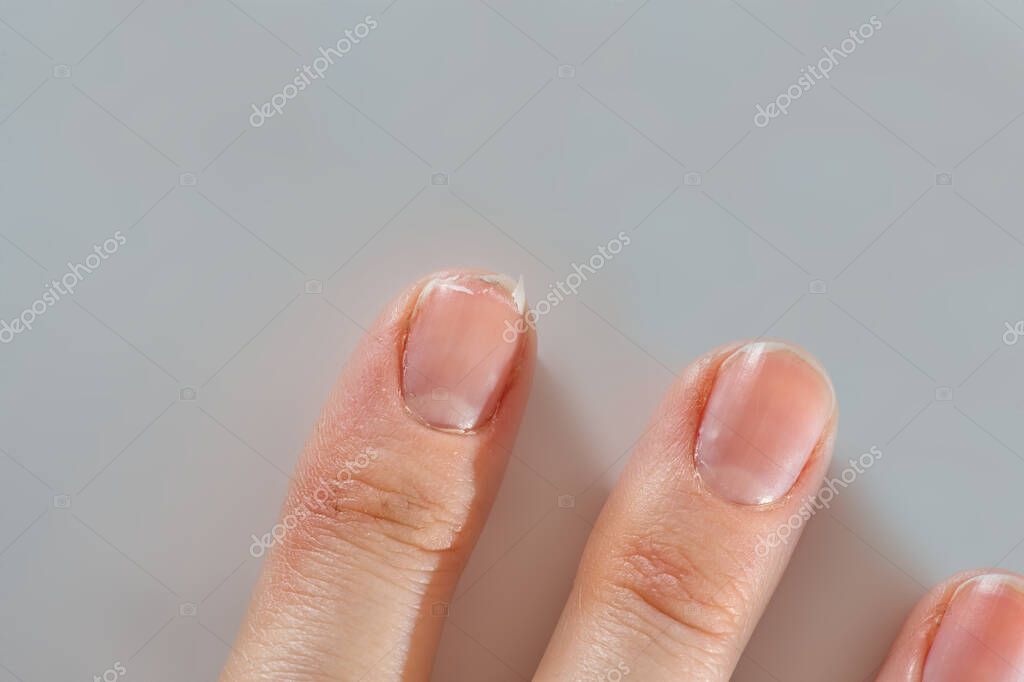 Close-up of brittle nails on womans hands. Female broken fingernail. weak sore nails.