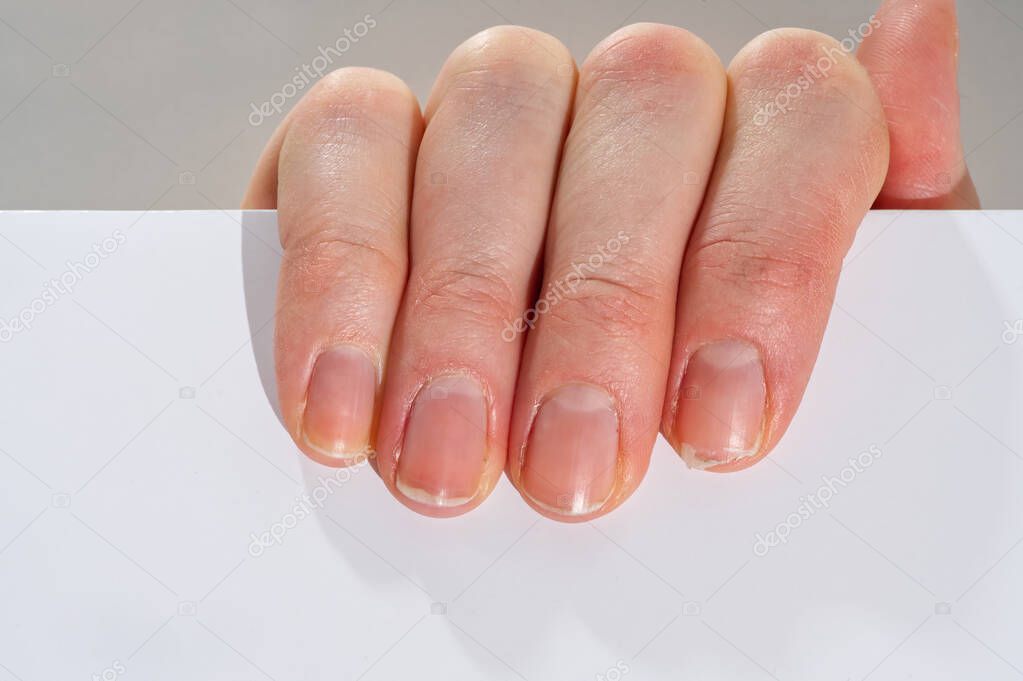 Close-up of brittle nails on womans hands. Female broken fingernail. weak sore nails.