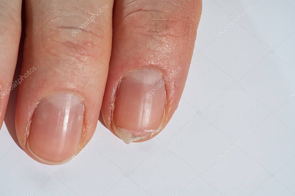 Close-up of brittle nails on womans hands. Female broken fingernail. weak sore nails.