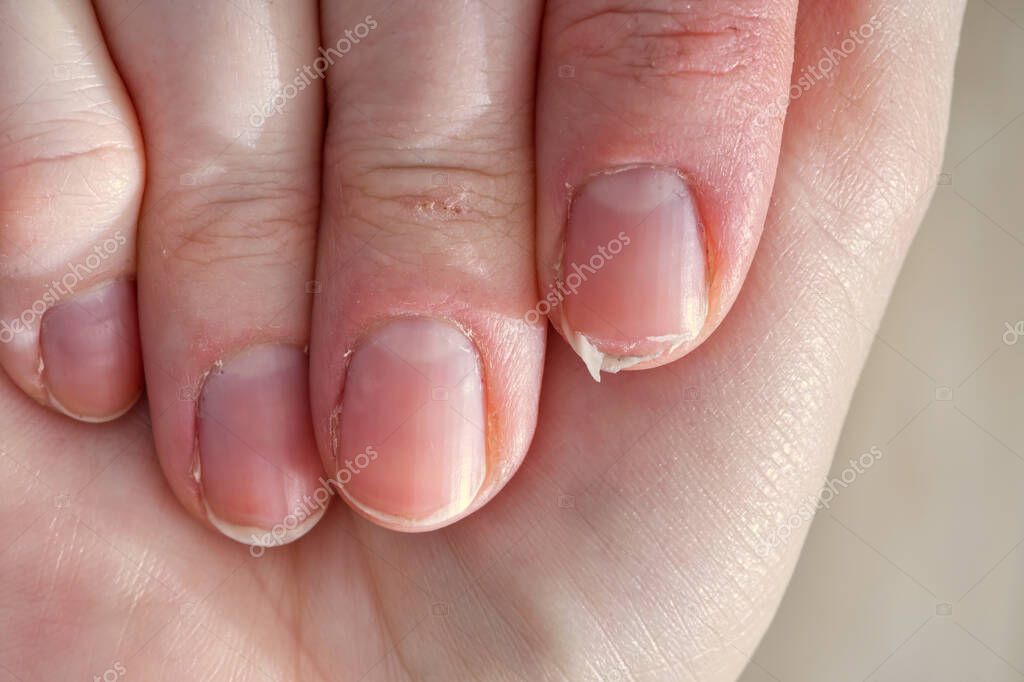 Close-up of brittle nails on womans hands. Female broken fingernail. weak sore nails.