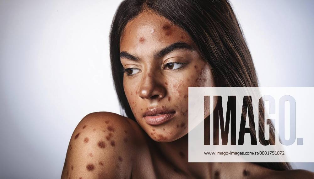 Nahaufnahme einer jungen Frau mit sichtbaren Affenpockenläsionen im Gesicht und am Körper, die die Symptome der Virusinfektion auf der Haut hervorheben, KI generiert Close-up portrait of a young woman with visible monkeypox lesions on her face and body, highlighting the symptoms of the viral infection on the skin, AI generated