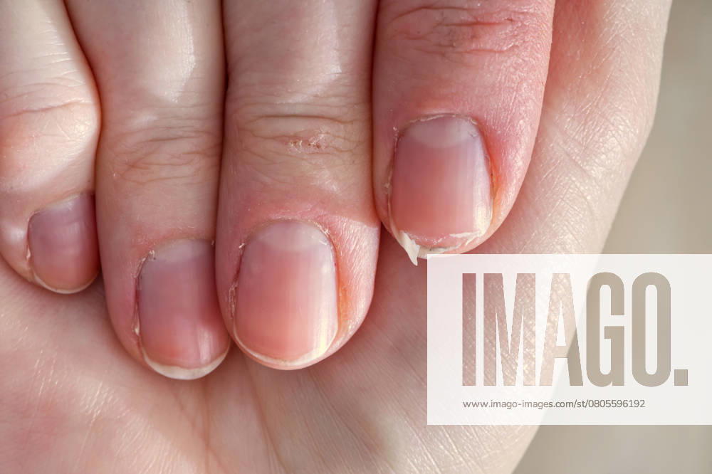 Close-up of brittle nails on woman s hands. Female broken fingernail. weak sore nails. , 51467094.jpg, nail, broken, closeup, finger, female, hand, woman, weak, sore, nails, health, care, skin, manicure, treatment, fingernail, pain, medical, healthy, hygiene, medicine, dry, clean, people, person, ridges, body, background, peeling, brittle, white, gel-lacquer, damaged, unhealthy, gesturing, pitted, fracture, makeup, shellac, break, accident, destroy, fresh, beauty RECORD DATE NOT STATED