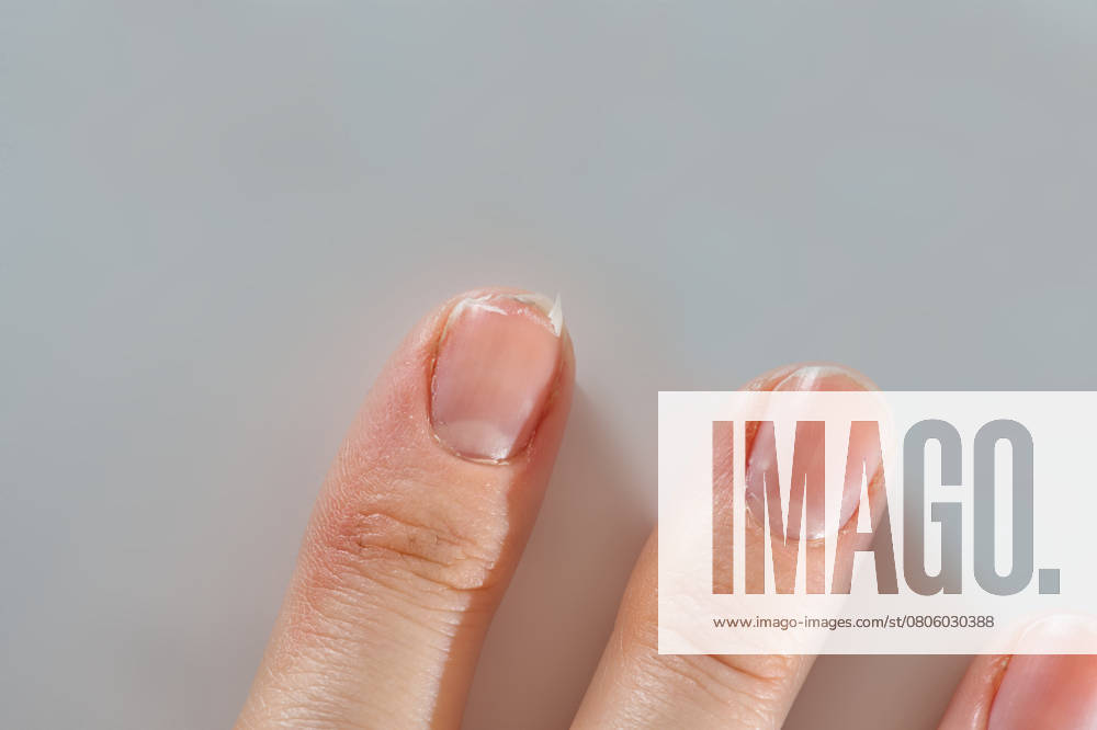 Close-up of brittle nails on woman s hands. Female broken fingernail. weak sore nails. , 51809682.jpg, nail, broken, closeup, finger, female, hand, woman, weak, sore, nails, health, care, skin, manicure, treatment, fingernail, pain, medical, healthy, hygiene, medicine, dry, clean, people, person, ridges, body, background, peeling, brittle, white, gel-lacquer, damaged, unhealthy, gesturing, pitted, fracture, makeup, shellac, break, accident, destroy, fresh, beauty RECORD DATE NOT STATED