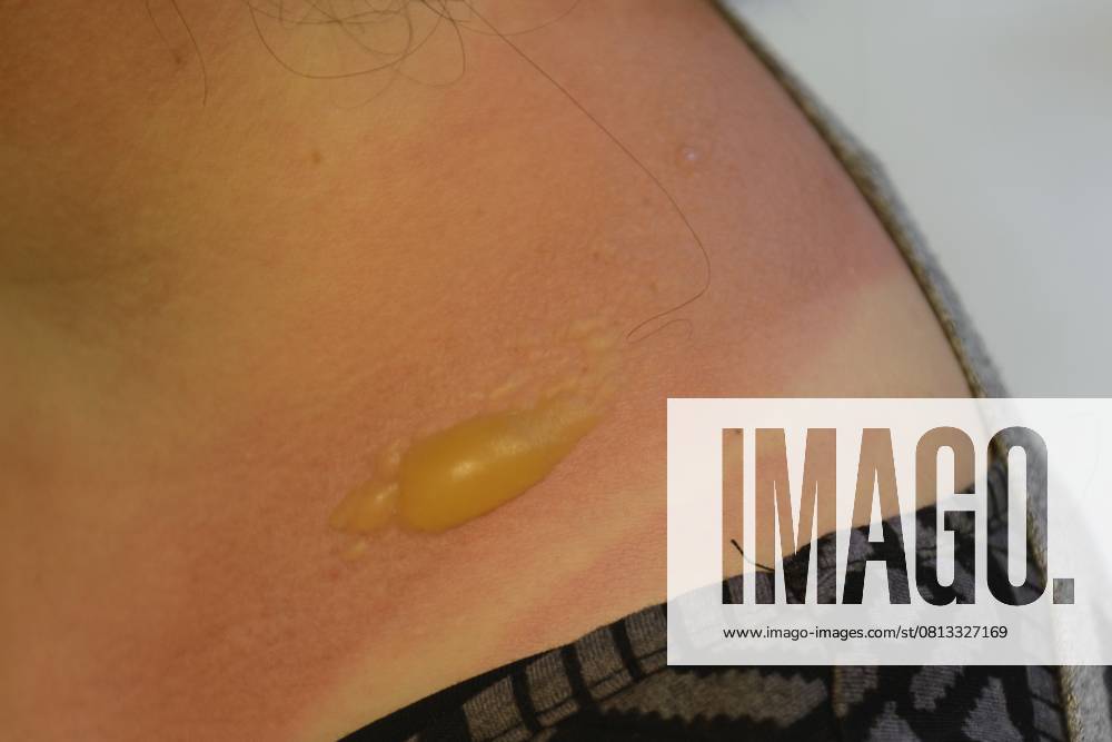 Sonnenbrand mit großer Brandblase auf der Schulter Sunburn with a large blister on the shoulder