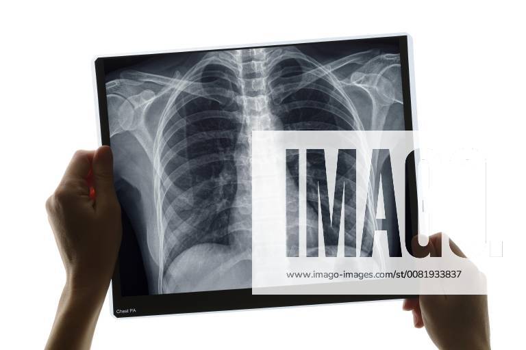 Diagnose mit Thorax-Röntgenbild