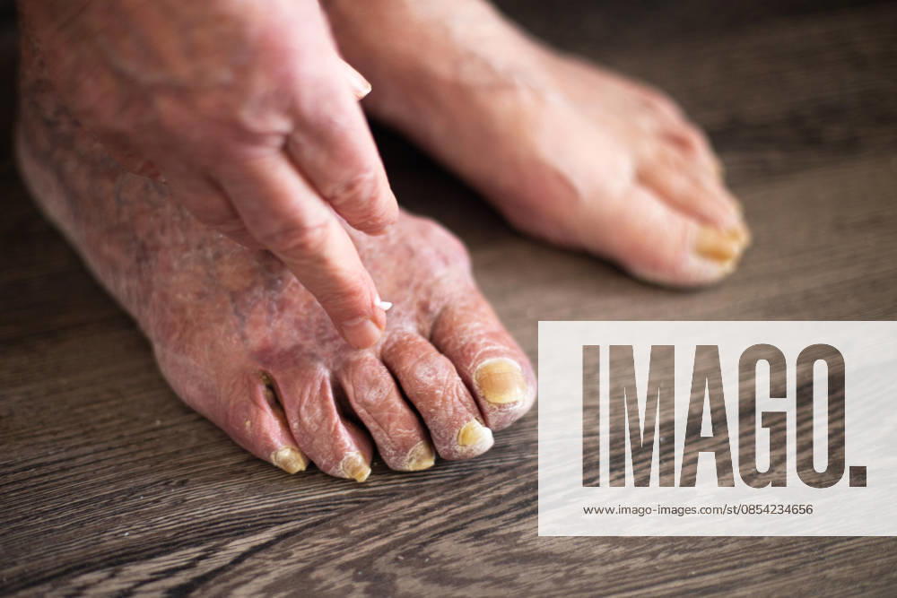 Eine ältere Person, die eine Salbe gegen eine Fußpilzinfektion aufträgt Older senior elderly person applying medicinal cream to toenails afflicted with onychomycosis. Legs treatment with fungal foot infection. (License=RF) ,model released, Symbolfoto