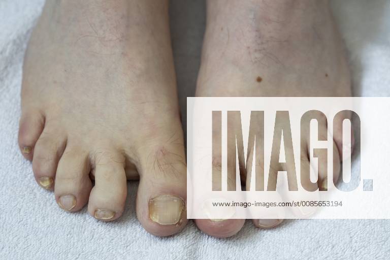 Füsse, Fussnägel, mit Nagelpilz Befall,