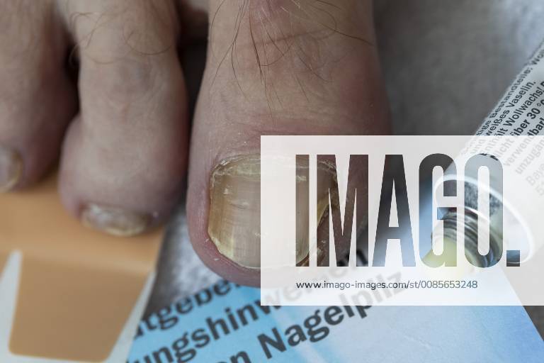 Fussnägel, mit Nagelpilz Befall, Salbe zur Behandlung, Abbau des erkrankten Nagelbetts,