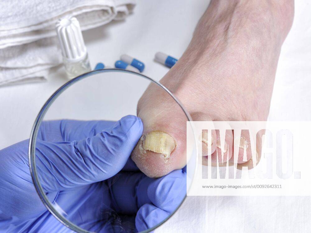 Dermatologist doctor visits the nails of a patient affected by onychomycosis following the action of pathogenic fungi.