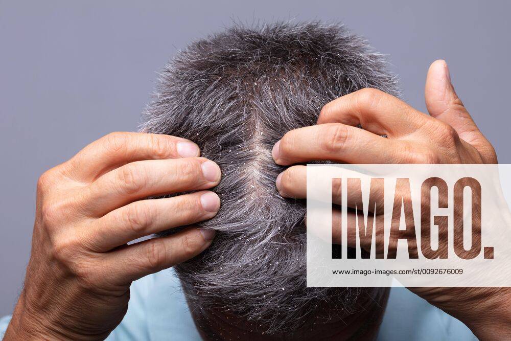 Dandruff On Man s Hair ,model released, Symbolfoto