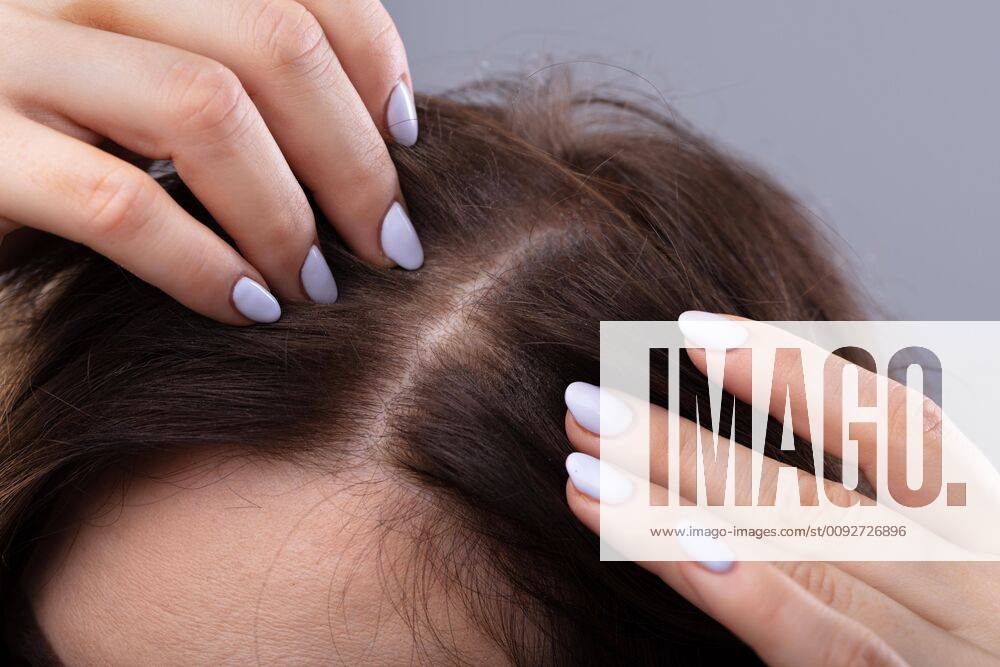 Woman With Thinning Hair ,model released, Symbolfoto