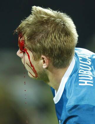 Tomas HUBOCAN, Zenit 14 wird durch Kniestoss Robert LEWANDOWSKI, BVB 9 schwer verletzt, Wunde, Verletzung, Blut, blutig, offene Wunde, Schnittverletzung, Cut, Platzwunde BORUSSIA DORTMUND - ZENIT St. PETERSBURG Fussball UEFA Champions League, Achtelfinale, Dortmund, 19.03.2014 CL Saison 2013 2014, S04