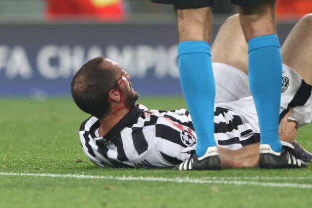 Aktuell Fußball, Champions League, Giorgio Chiellini von Juventus Turin spielt nach Verletzung mit Kopfverband weiter May 5, 2015 - Turin, Italy - Juventus defender Giorgio Chiellini (3) lies on the pitch injured during the Uefa Champions League semi finals football match JUVENTUS - REAL MADRID on 05 05 15 at the Juventus Stadium in Turin, Italy. Copyright 2015 Matteo Bottanelli Juventus v Real Madrid CF - UEFA Champions League Semi Final  - ZUMAn230