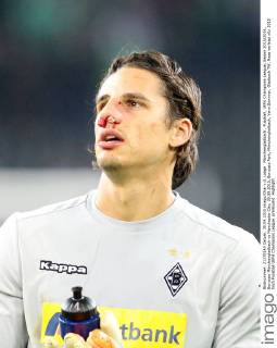 Mönchengladbach , Fussball, UEFA Champions League, Saison 2015 2016, Borussia Mönchengladbach vs Manchester City, 30.09.2015, Borussia Park, Mönchengladbach, Yann Sommer, Gladbach TW, Nase verletzt