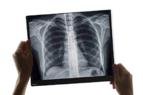 Diagnose mit Thorax-Röntgenbild Copyright: imageBROKER/SimonxBelcher ibxdig04631305.jpg