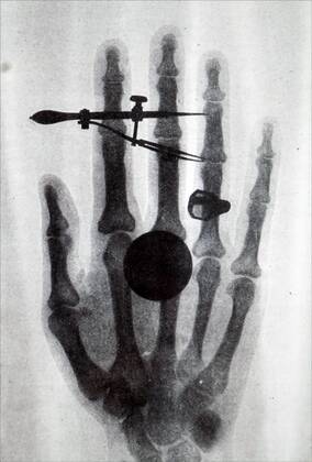 Early Röntgen X-Ray of Wilhelm Röntgen wife s hand. Wilhelm Röntgen (1845-1923) a German mechanical engineer and physicist, who produced and detected electromagnetic radiation in a wavelength range known as X-rays of Röntgen Rays. Dated 19th century 917_05_WHA_102_0062