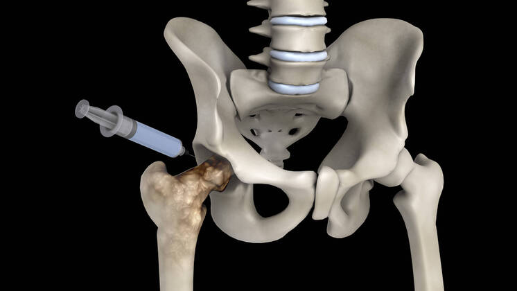 Biomedical illustration showing the treatment of osteoporosis. Copyright: StocktrekxImages STK701549H