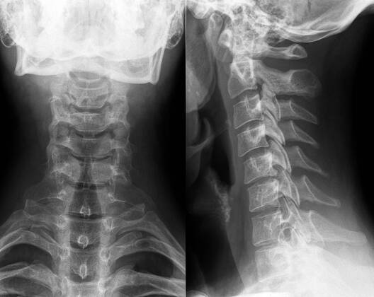 röntgenbild,röntgen,halswirbel,röntgenaufnahme,röntgenaufnahmen,röntgenbilder,halswirbelsäule,hws,pars cervicalis